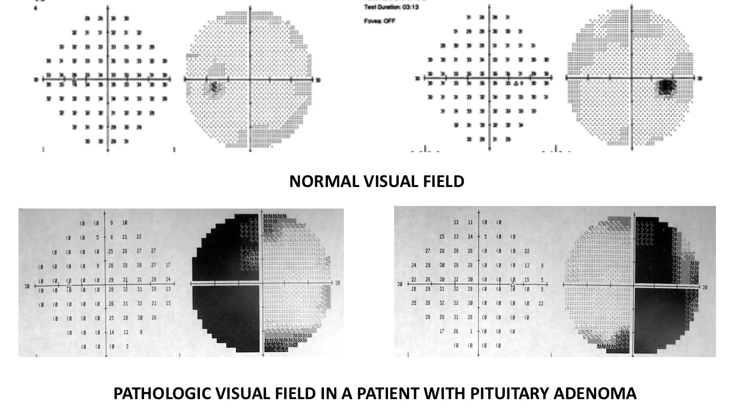 Non-Functioning Pituitary Adenomas - Pietro Mortini